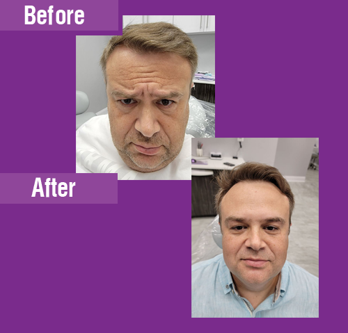 Facial muscle relaxation treatment before and after result 2